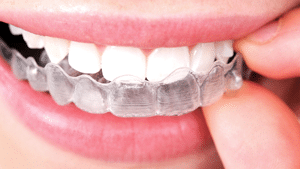 Invisalign in Lees Summit and Pleasant Hill MO