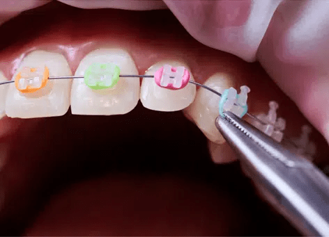 braces lee's summit