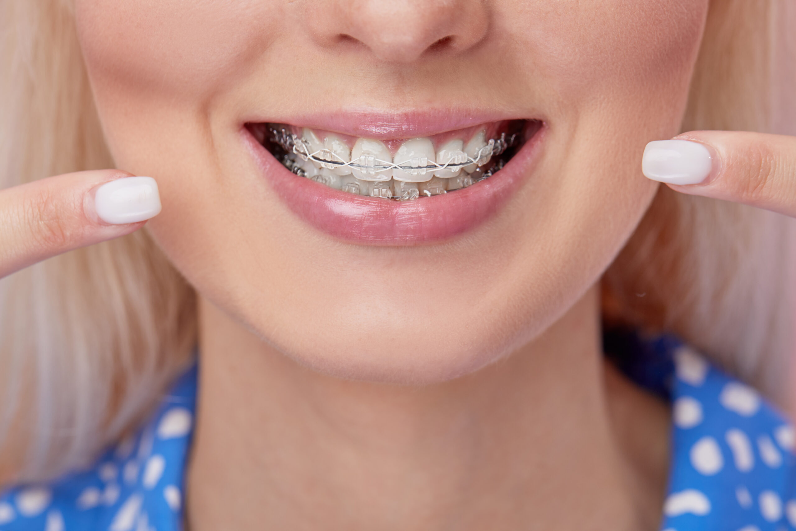 The Benefits of "Invisible Braces"
